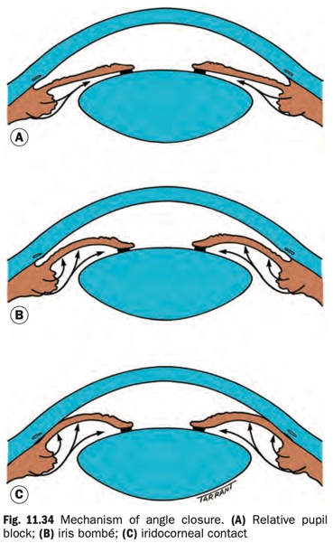 Mechanism of angle closure