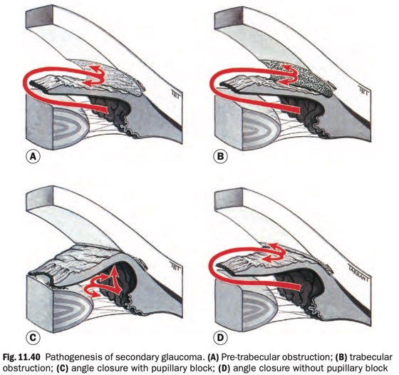 Pathogenesis of secondary glaucoma